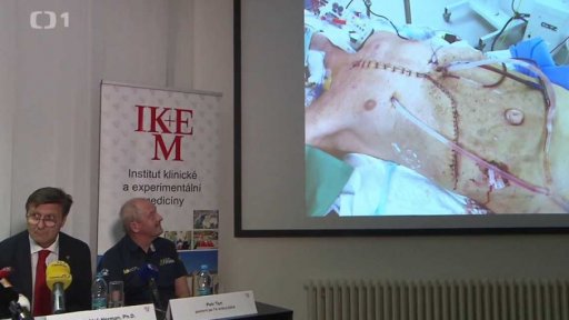 Dvojitá transplantace