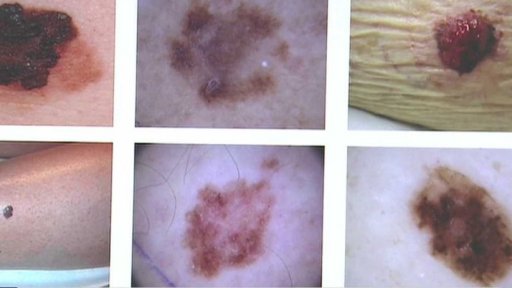 Imunoterapie a léčba rakoviny