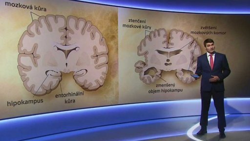 Alzheimerova choroba