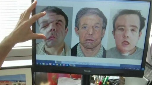 Dvě transplantace obličeje