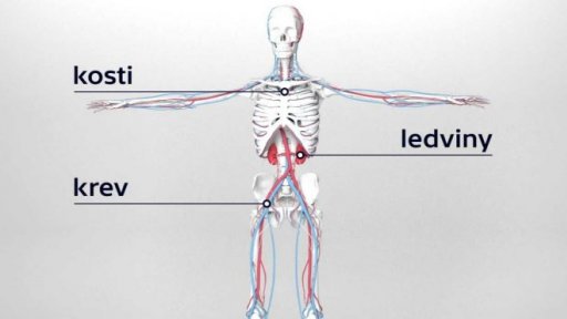 Léčba mnohočetného myelomu