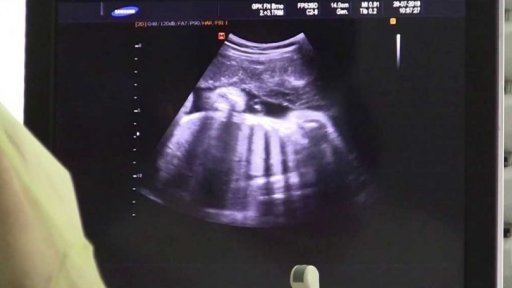 Unikátní porod po mozkové smrti