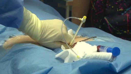 Nový typ bezdrátového kardiostimulátoru