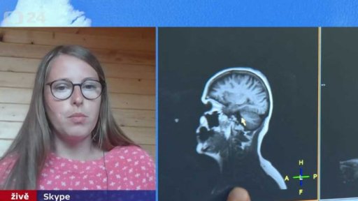 Migréna jako překážka v zaměstnání