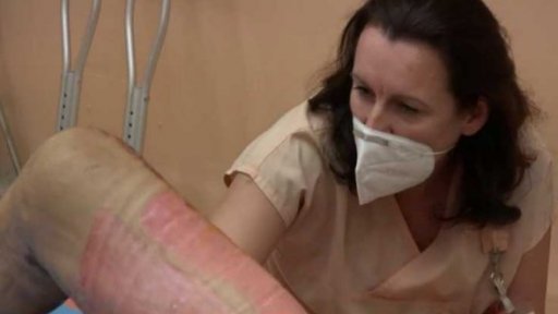 Mezinárodní den boje proti popáleninám