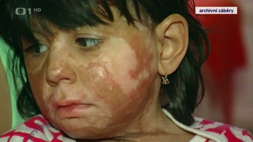 Sbírka pro rodinu popálené dívky