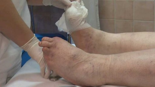 Syndrom diabetické nohy