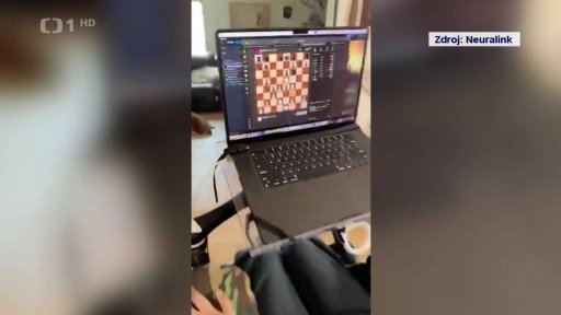 Muž s implantovaným čipem Neuralink