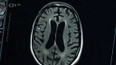 Krevní testy na Alzheimerovu chorobu