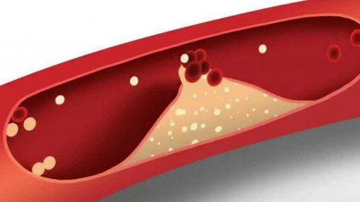 Vysoká hladina cholesterolu trápí většinu dospělých Čechů