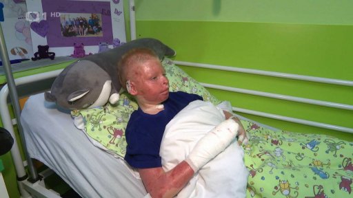 Lékaři zachránili život popálenému chlapci