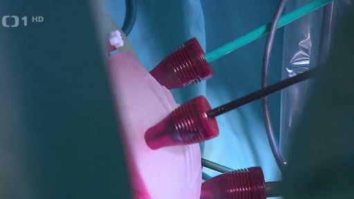 Rozšíření gynekologických miniinvazních operací