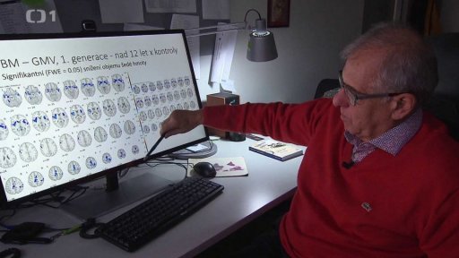 Trauma v šedé hmotě