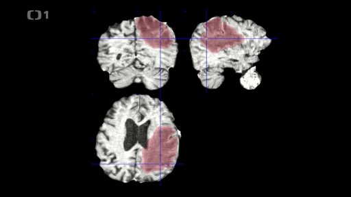 O vědě a vědcích: Umělá inteligence v onkologii