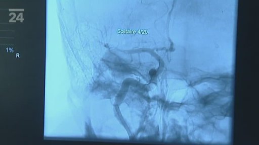 Cévní mozková příhoda