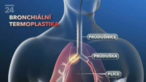 Termoplastika průdušek
