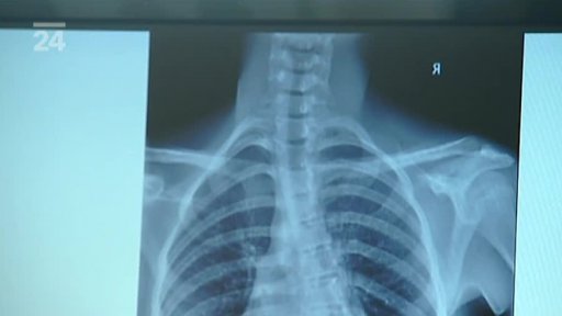 Unikátní operace skoliózy