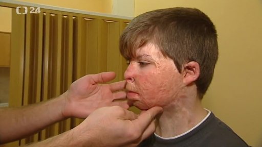 Laserem na následky popálenin