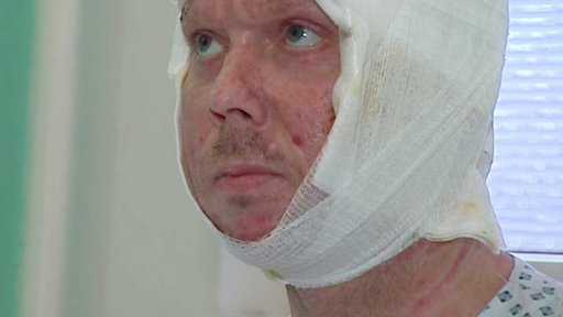 Popálený horník může domů